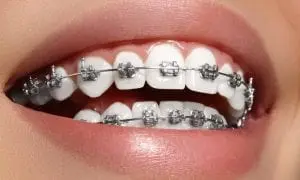 Ingrijirea dintilor cand porti aparat dentar
