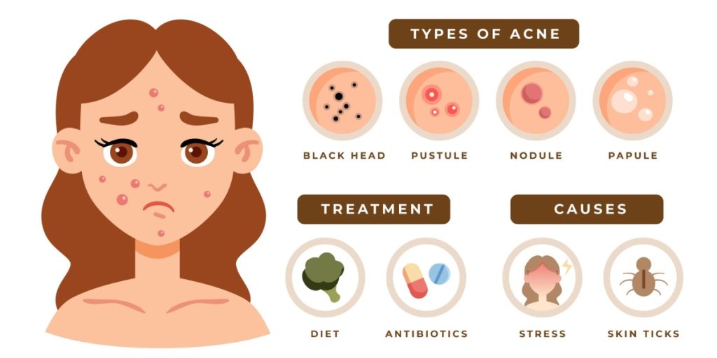cauze acnee